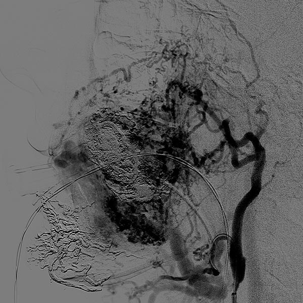 Compva Large Arteriovenous Malformation Of The Cheek