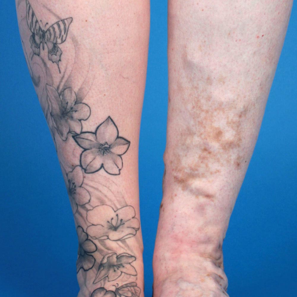 Think Before You Ink The 13 Risks of Tattooing Over Varicose Veins  Vein  Envy